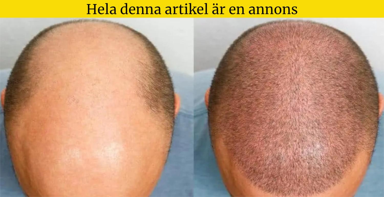 Före och efter bilder som visar hårväxt på en manlig hårbotten, där den vänstra sidan ser kal och den högra sidan visar ökad hårtäckning. Text på svenska överst.
